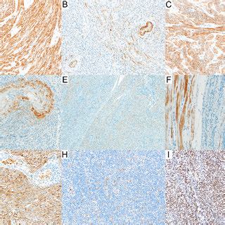 Immunohistochemical Findings In Cellular Leiomyomas A Tumor Cells