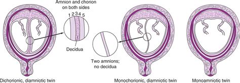 Icd 9 Dichorionic Diamniotic Twins