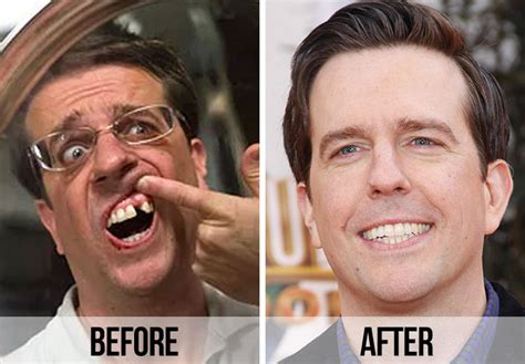 Celebrity Dental Implants And Veneers Before And After Shefinds