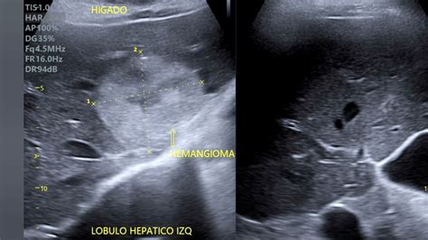 Hemangioma Hep Tico Tumor Benigno Del H Gado Causas S Ntomas Y