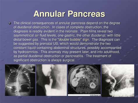 Ppt The Pancreas Powerpoint Presentation Free Download Id146163