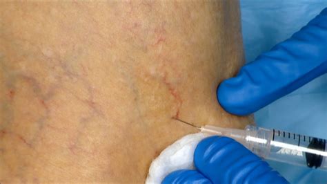 Injection Sclerotherapy Treatment For Spider Veins Youtube