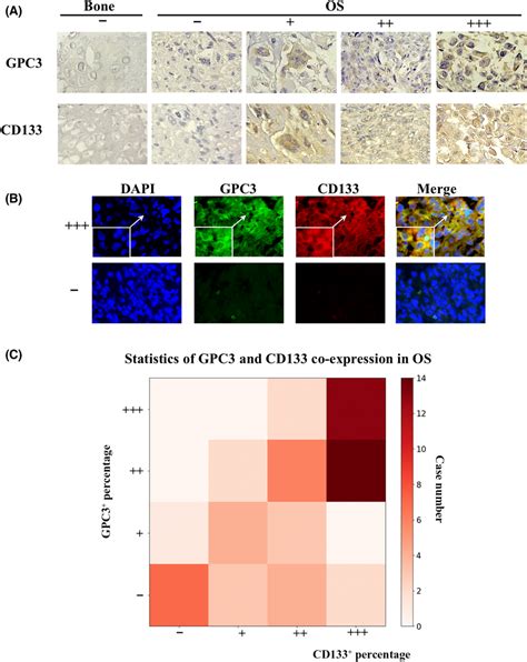 Correlation Analyses Of Gpc3 And Cd133 Expression In Os Tissues And