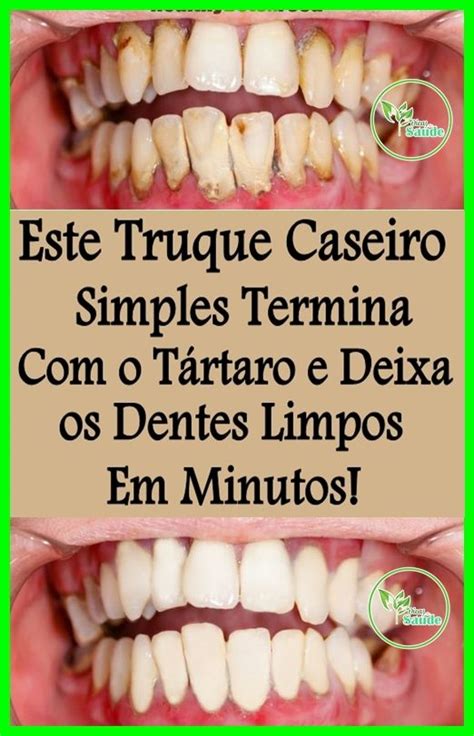 Receita Caseira Para Remover Os T Rtaros Dos Dentes Em Minutos