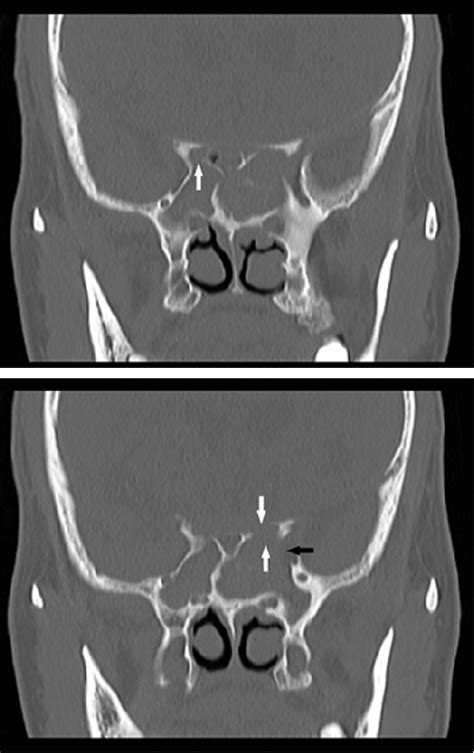 Figure 3 From Sphenoid Sinus Fungus Ball Presenting With Bilateral Visual Disturbance Semantic