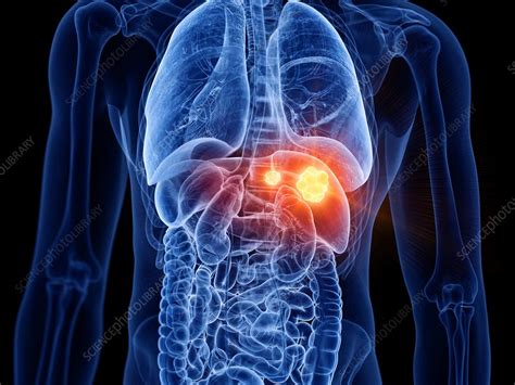 Liver Cancer Illustration Stock Image F0276111 Science Photo Library