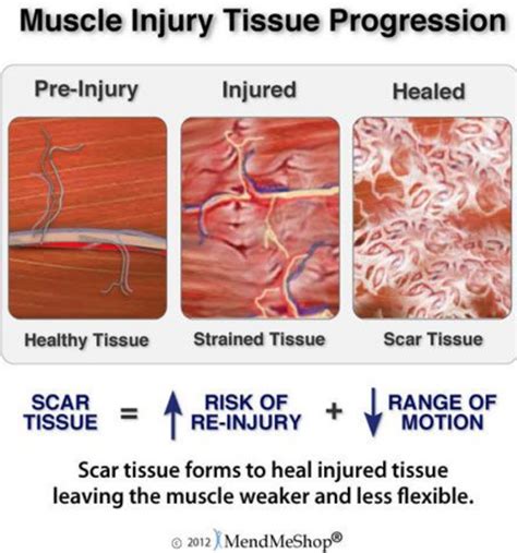 ☮ Massage For Muscle Tears ⋆ Santa Barbara Deep Tissue Riktr Pro