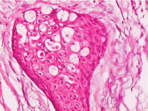 Photomicrograph Showing Islands Of Squamous Odontogenic Epithelium