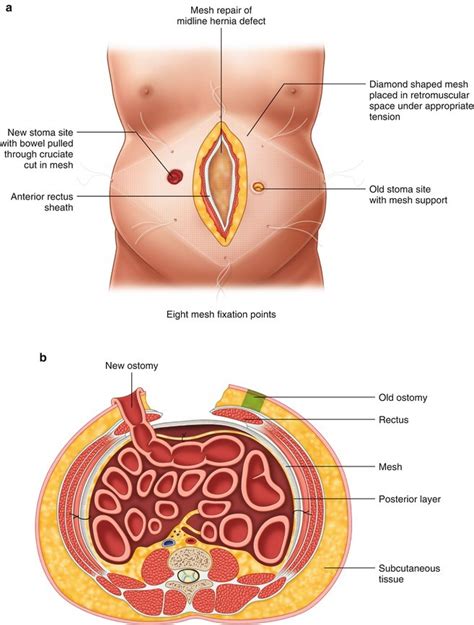 Open Parastomal Hernia Repair Springerlink