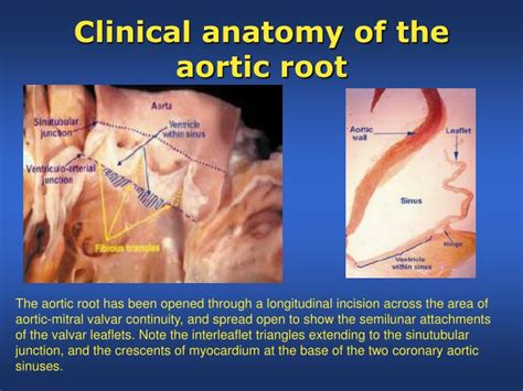 Ppt Aortic Regurgitation And Aortic Leaflet Repair Powerpoint