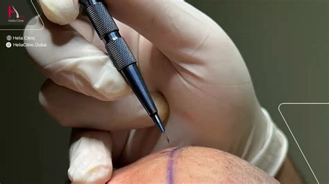 Sapphire Fue Hair Transplant Beyond Expectations Helia Clinic