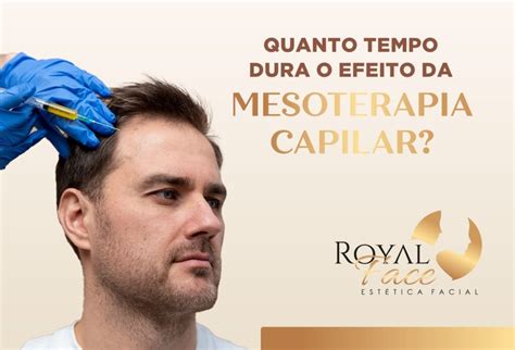 O Efeito Da Mesoterapia Capilar Quanto Tempo Dura