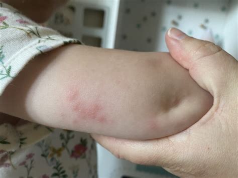 Bed Bug Bites Vs Flea Bites