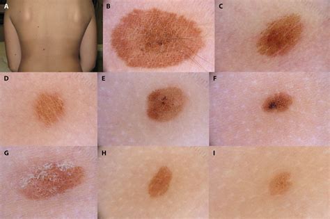 A 10 Year Old Girl With Multiple Nevi Based On The History The Only Download Scientific