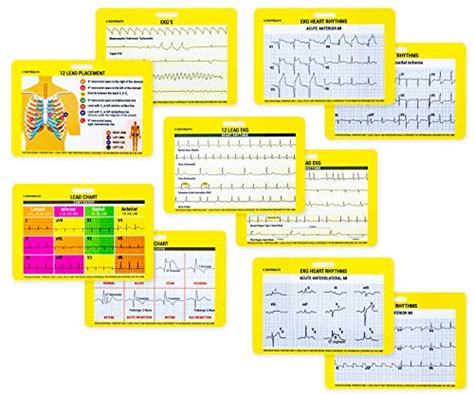 Snapklik Ekg Card Set Common Cardiac Rythms Lead Placement