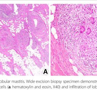 Microscopic Image In Plasma Cell Mastitis Inflammatory Infiltrate With