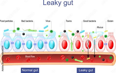 Leaky gut. Intestinal permeability. Gut barrier dysfunction. Stock Vector | Adobe Stock