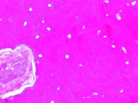 Photomicrograph Of The Bone Sequestrum Showing Fragments Of Bone Tissue