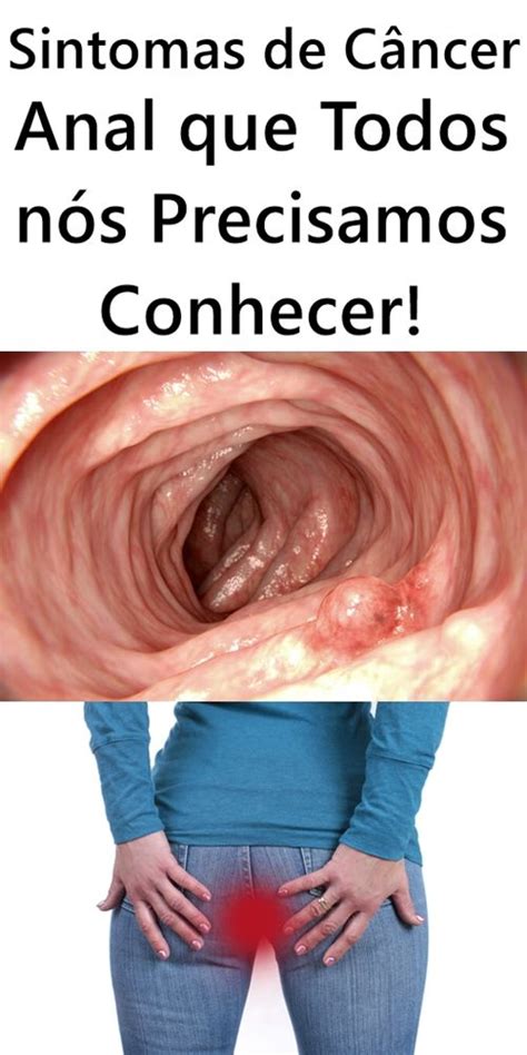 Sintomas do câncer anal a doença silenciosa que você precisa saber Artofit