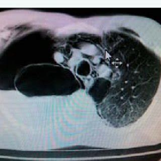 Show CXR and left side huge bullae. | Download Scientific Diagram