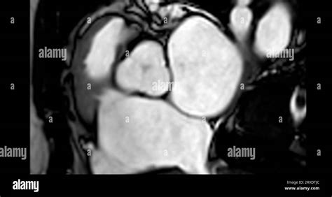 MRI heart or Cardiac MRI ( magnetic resonance imaging ) of heart showing aortic valve Stock ...