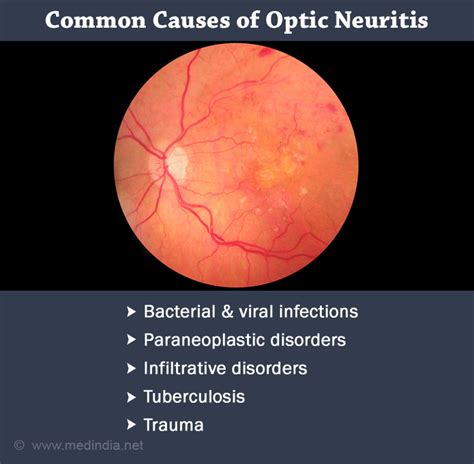 Home Remedies for Optic Neuritis