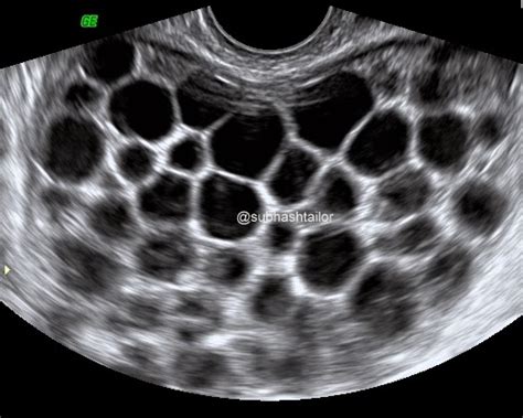 Sono Digest Pelvic Broad Ligament Hydatid Cyst An Ultrasound Diagnosis