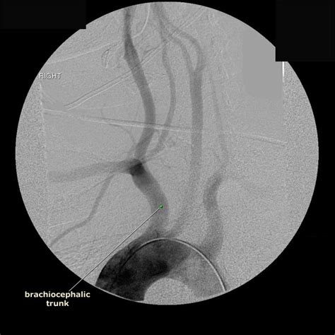 Index of /Neuro/Radiology/rad_vasculature/angio_aortic_arch/early