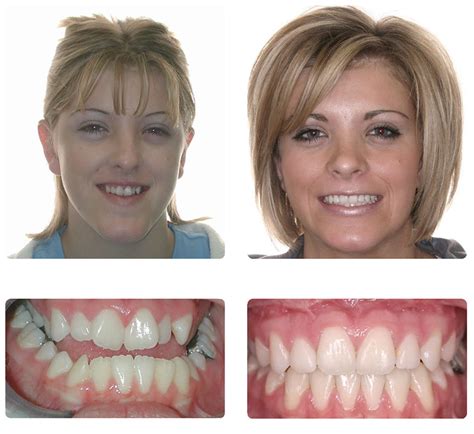 Smile Gallery Coombs Orthodontics Clinton Layton Ut