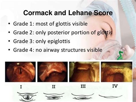 Preop Eval And Airway Management