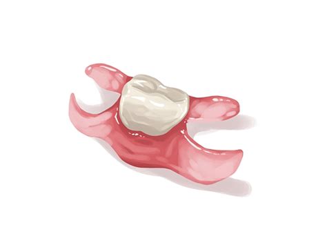 Best Metal Partial Dentures In Rogers Ar Exo Dental