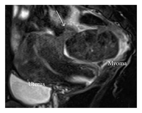 Sagittal T2 Weighted Mri Showing A Torted Pedicle Of The Subserosal