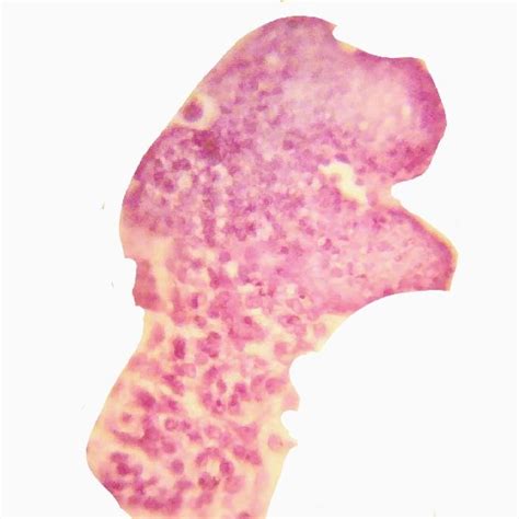 Microscopic picture of decidual cast with infiltration of decidua by... | Download Scientific ...