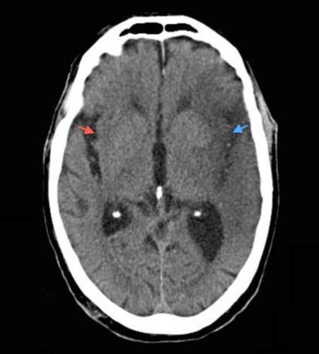 Cerebrovascular Disease Part Flashcards Quizlet