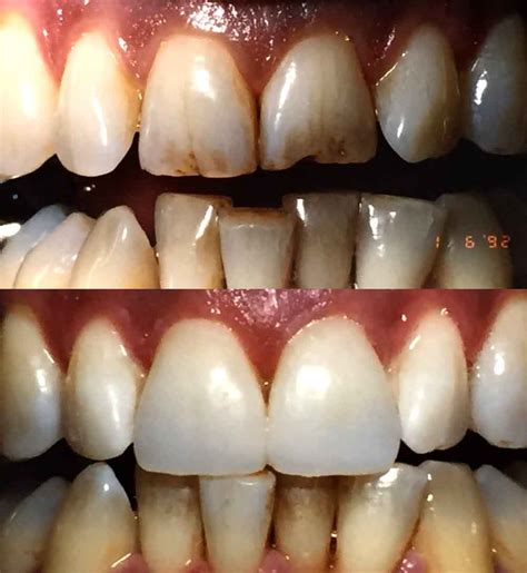 Resin Bonding of upper two front teeth - Carroll Dental Care