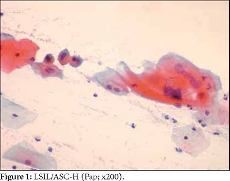 Figure 1 from LSIL/ASC-H (LSIL-H) in cervicovaginal smear ...