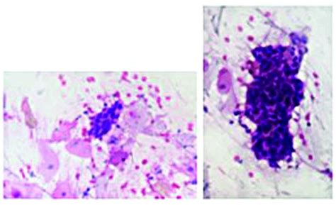 Hsil Anal Cytoloty X And X High Grade Squamous Intraepithelial