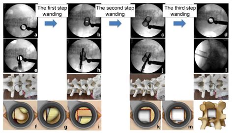 Jcm Free Full Text Posterior Oblique Square Decompression With A Three Step Wanding