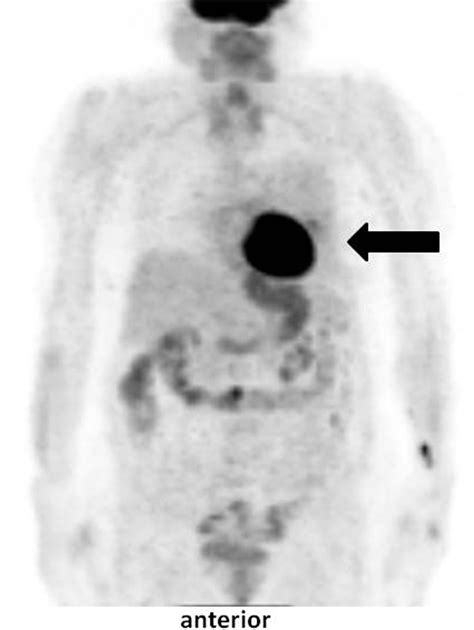 Positron emission tomography scan | Download Scientific Diagram 