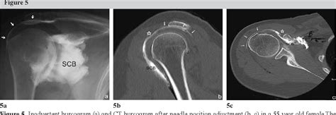 Figure 5 from Subcoracoid Bursa: Imaging Diagnosis and Significance ...