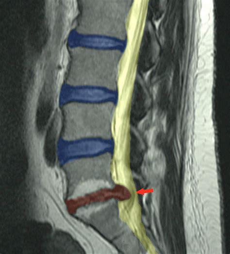 Lumbar Disc Herniation Mark Nelson M D