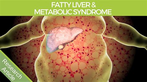 Fatty Liver Treatment Nz Fatty Liver Detox