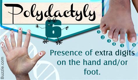 Understanding the Genetics of Polydactyly in Humans Just Got Easier ...