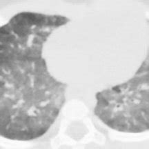 Postmortem Axial Chest Ct Shows Normal Pulmonary Edema In A Month Old