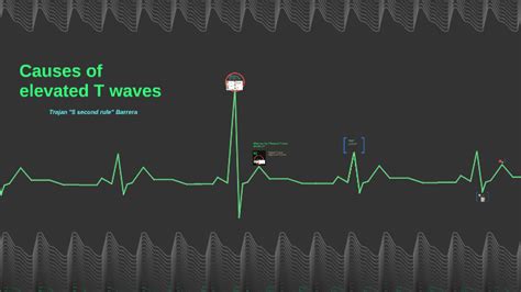 Causes of T wave elevation by Trajan Barrera on Prezi