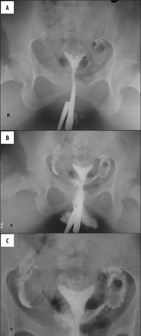 Figure 2 From Contrast Intravasation During Hysterosalpingography