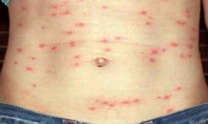 Epidemic Typhus Fever Rash Pictures Images Photo E Medical Updates