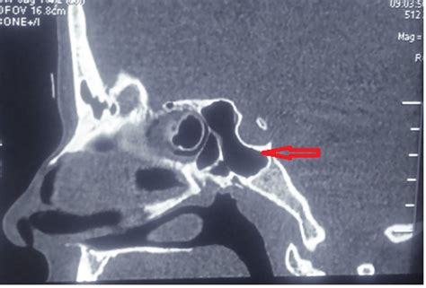 Anatomical Variations Of Sphenoid Sinus I N Patients With Sino Nasal