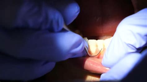 Scaling And Root Planing What To Expect During A Deep Teeth Cleaning