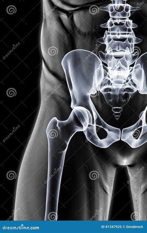 Ct Scan Pelvis Impression Transverse Fracture Of Acetabulum